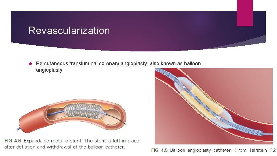 Revascularization Percutaneous transluminal coronary angioplasty, also known as balloon angioplasty Revascularization Percutaneous transluminal coronary angioplasty, also known as balloon angioplasty