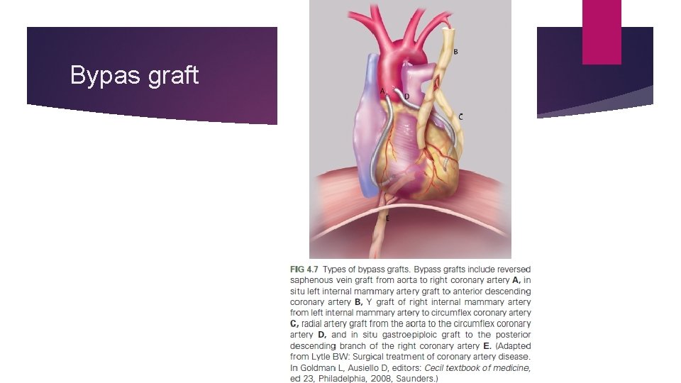 Bypas graft Bypas graft