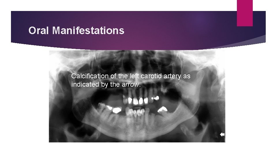 Oral Manifestations Calcification of the left carotid artery as indicated by the arrow. Oral Manifestations Calcification of the left carotid artery as indicated by the arrow.