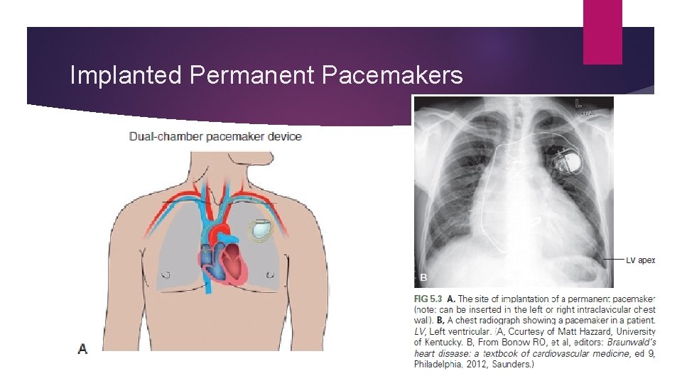Implanted Permanent Pacemakers Implanted Permanent Pacemakers