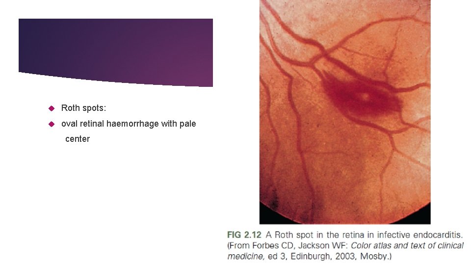 Roth spots: oval retinal haemorrhage with pale center Roth spots: oval retinal haemorrhage with pale center