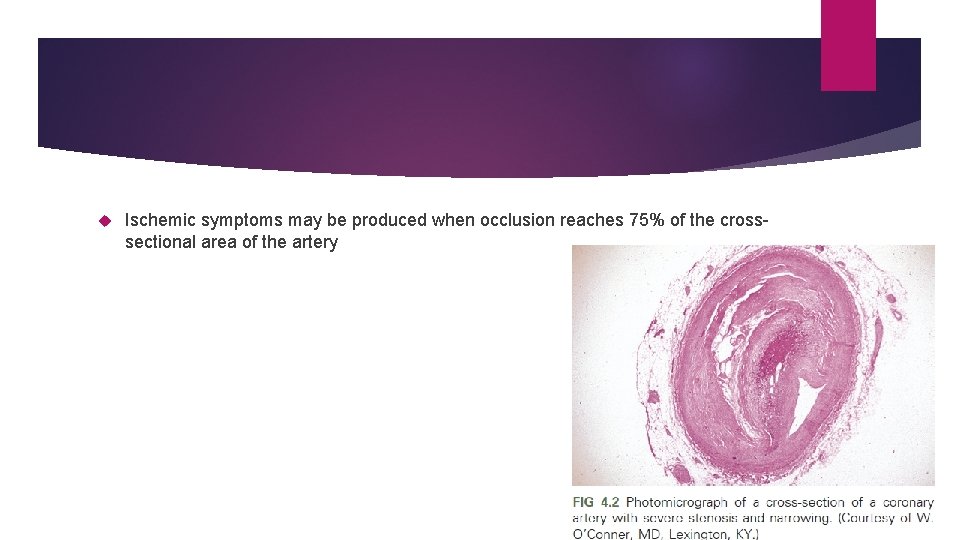 Ischemic symptoms may be produced when occlusion reaches 75% of the crosssectional area Ischemic symptoms may be produced when occlusion reaches 75% of the crosssectional area