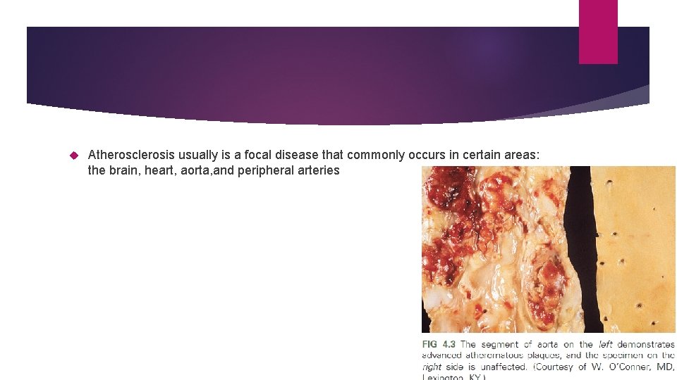 Atherosclerosis usually is a focal disease that commonly occurs in certain areas: the Atherosclerosis usually is a focal disease that commonly occurs in certain areas: the