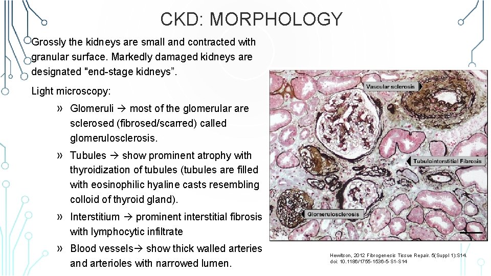 CKD: MORPHOLOGY Grossly the kidneys are small and contracted with granular surface. Markedly damaged
