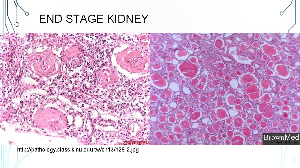 END STAGE KIDNEY http: //pathology. class. kmu. edu. tw/ch 13/129 -2. jpg 