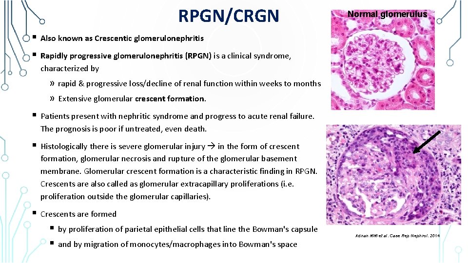 RPGN/CRGN § Also known as Crescentic glomerulonephritis § Rapidly progressive glomerulonephritis (RPGN) is a