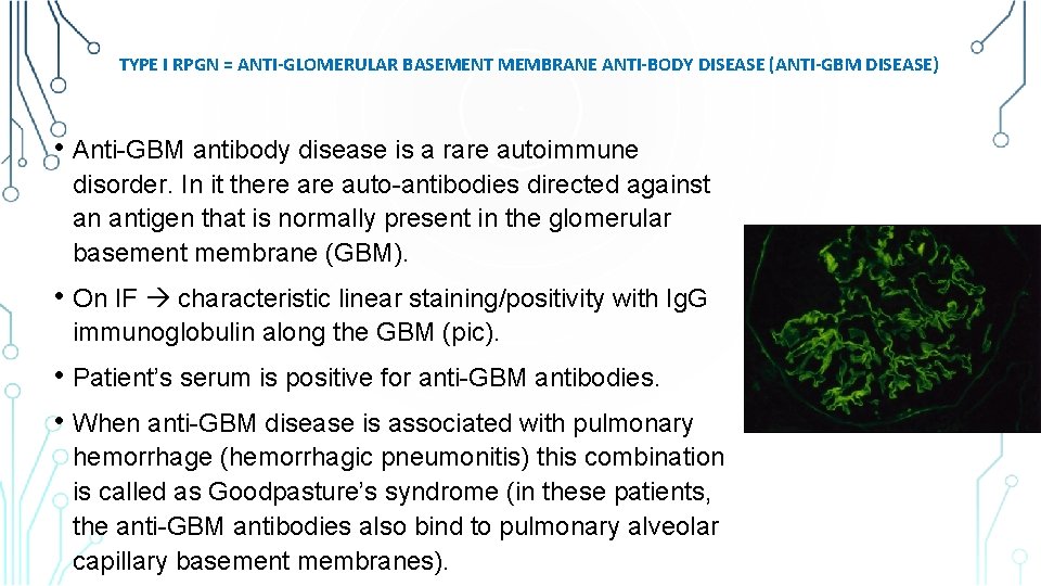 TYPE I RPGN = ANTI-GLOMERULAR BASEMENT MEMBRANE ANTI-BODY DISEASE (ANTI-GBM DISEASE) • Anti-GBM antibody