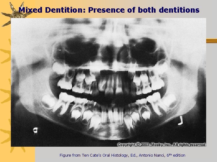 Mixed Dentition: Presence of both dentitions Figure from Ten Cate’s Oral Histology, Ed. ,