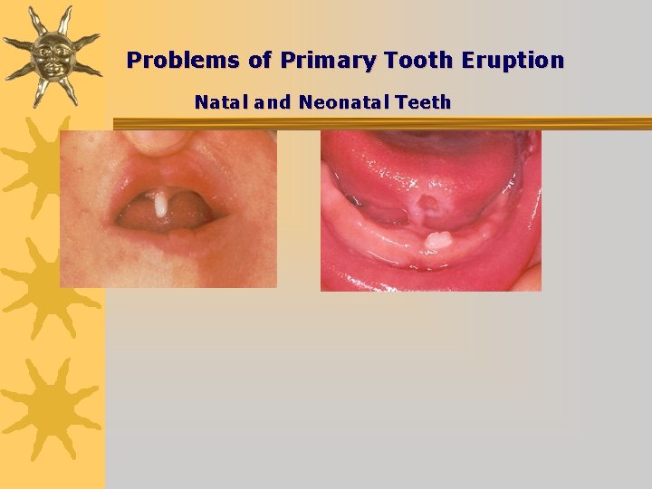 Problems of Primary Tooth Eruption Natal and Neonatal Teeth 