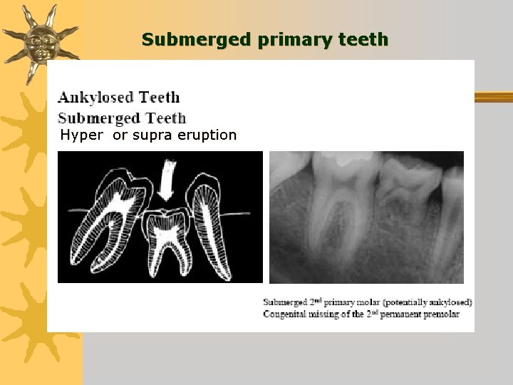Submerged primary teeth Hyper or supra eruption 