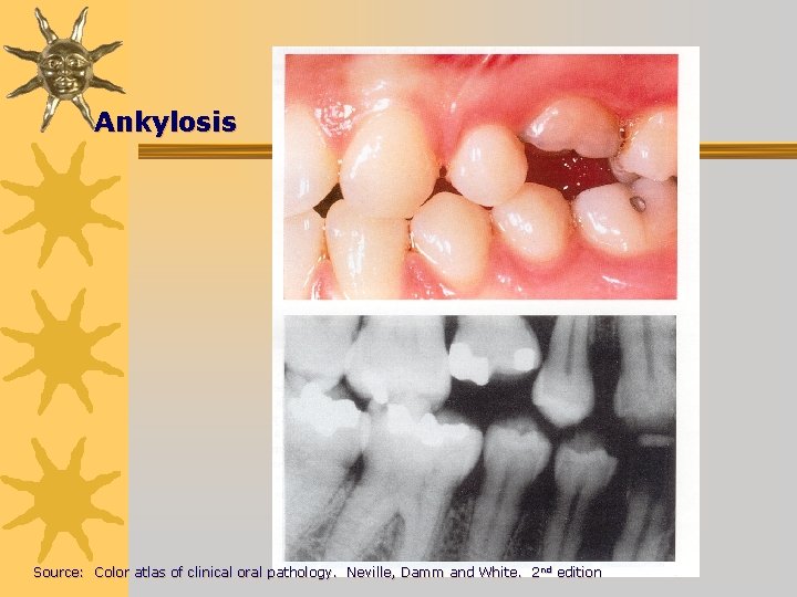 Ankylosis Source: Color atlas of clinical oral pathology. Neville, Damm and White. 2 nd