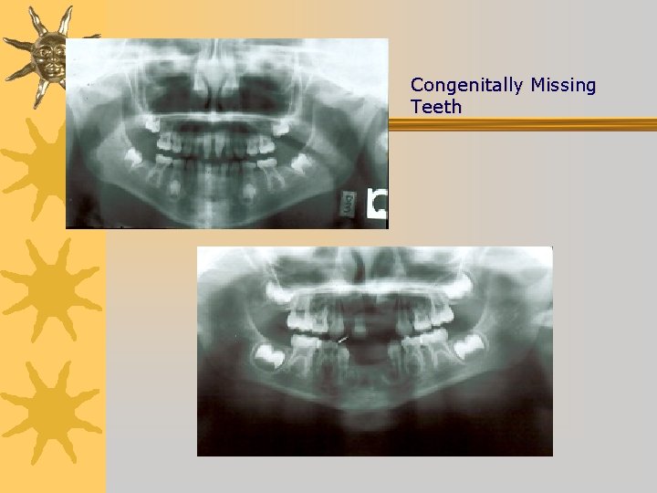 Congenitally Missing Teeth 
