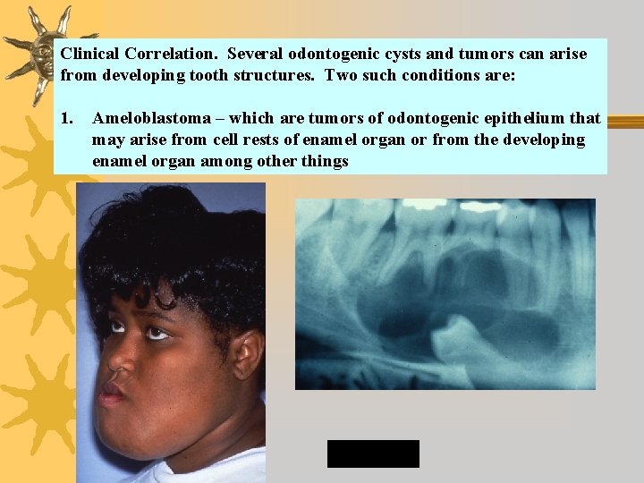 Clinical Correlation. Several odontogenic cysts and tumors can arise from developing tooth structures. Two