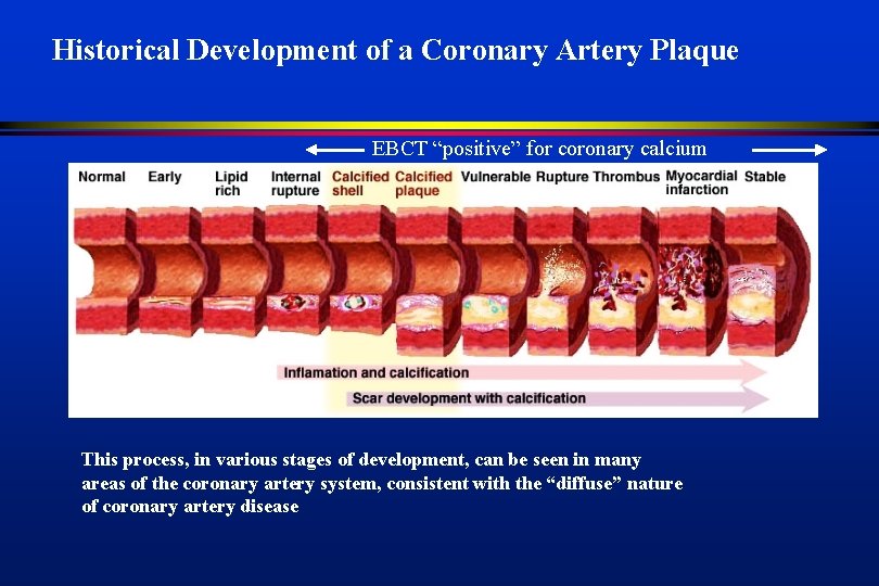 Historical Development of a Coronary Artery Plaque EBCT “positive” for coronary calcium This process,