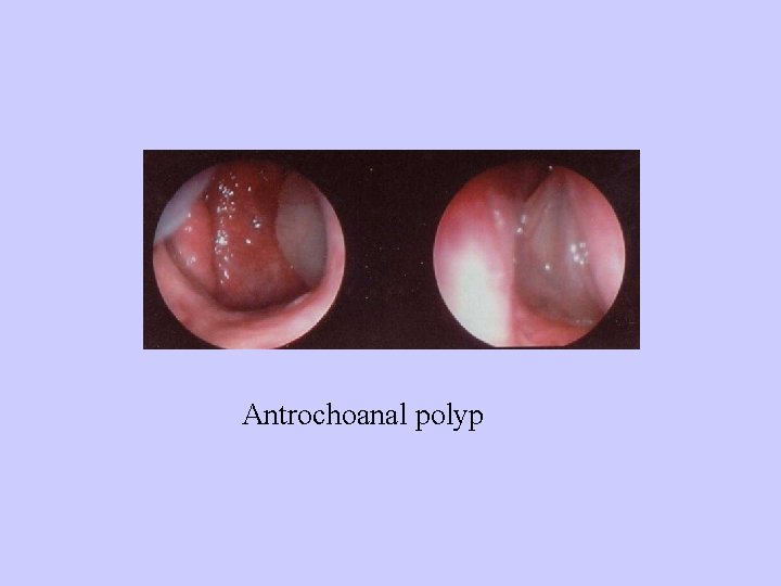 Antrochoanal polyp 