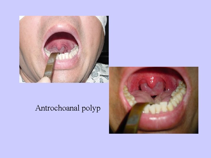 Antrochoanal polyp 