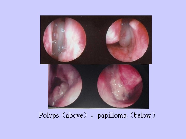 Polyps（above），papilloma（below） 