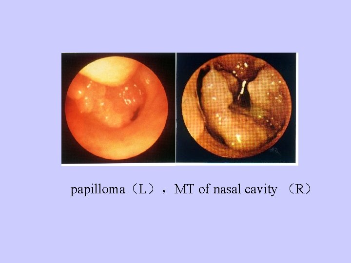 papilloma（L），MT of nasal cavity （R） 