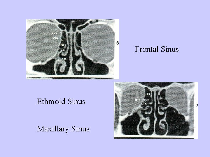 Frontal Sinus Ethmoid Sinus Maxillary Sinus 