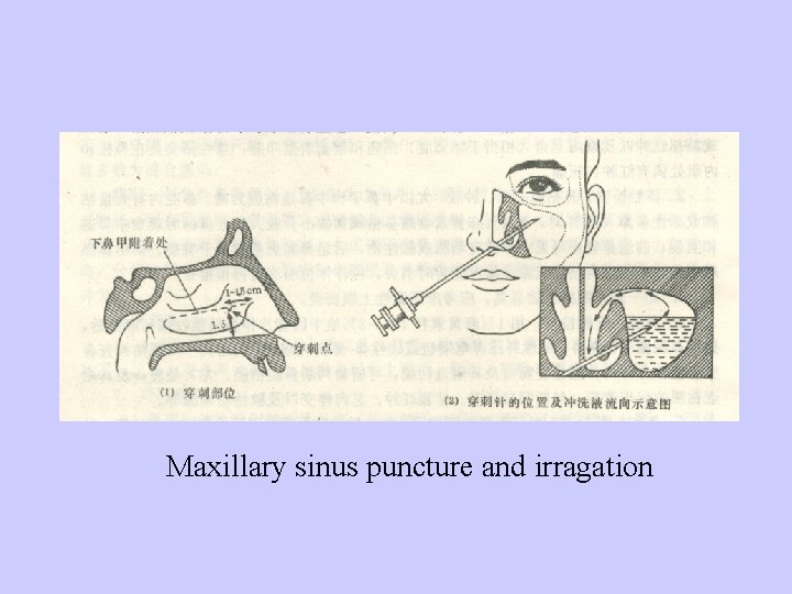 Maxillary sinus puncture and irragation 