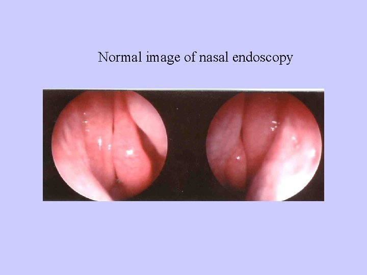 Normal image of nasal endoscopy 