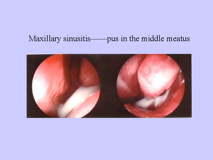 Maxillary sinusitis——pus in the middle meatus 