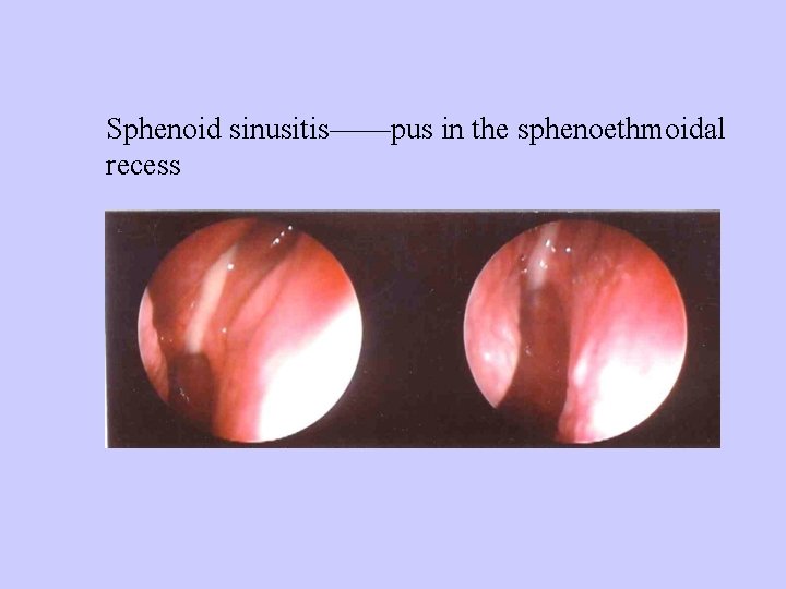 Sphenoid sinusitis——pus in the sphenoethmoidal recess 