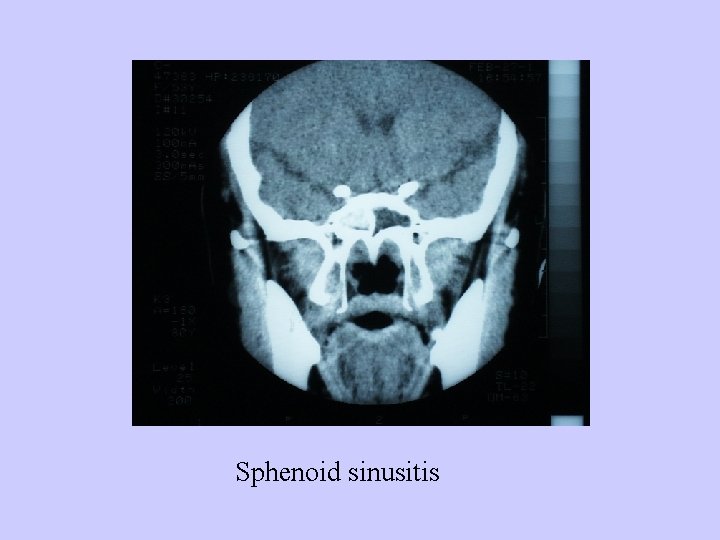 Sphenoid sinusitis 