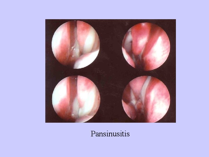 Pansinusitis 