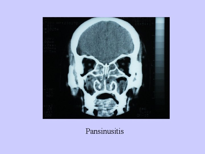 Pansinusitis 