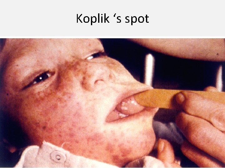 Koplik ‘s spot 