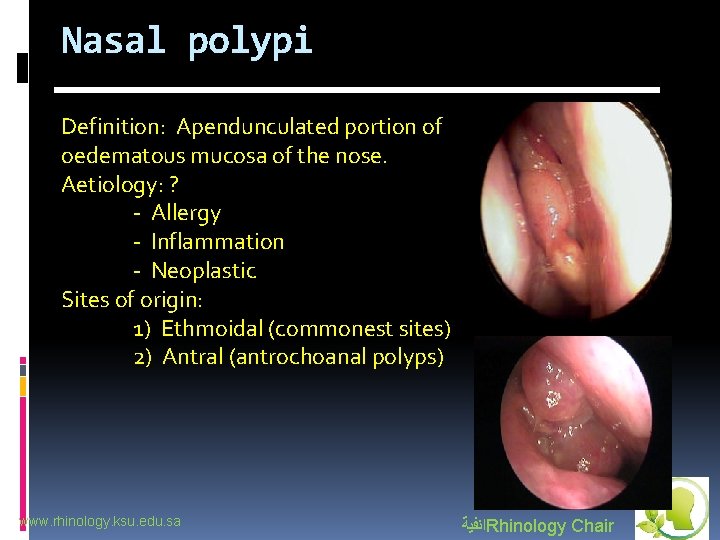 Nasal polypi Definition: Apendunculated portion of oedematous mucosa of the nose. Aetiology: ? -