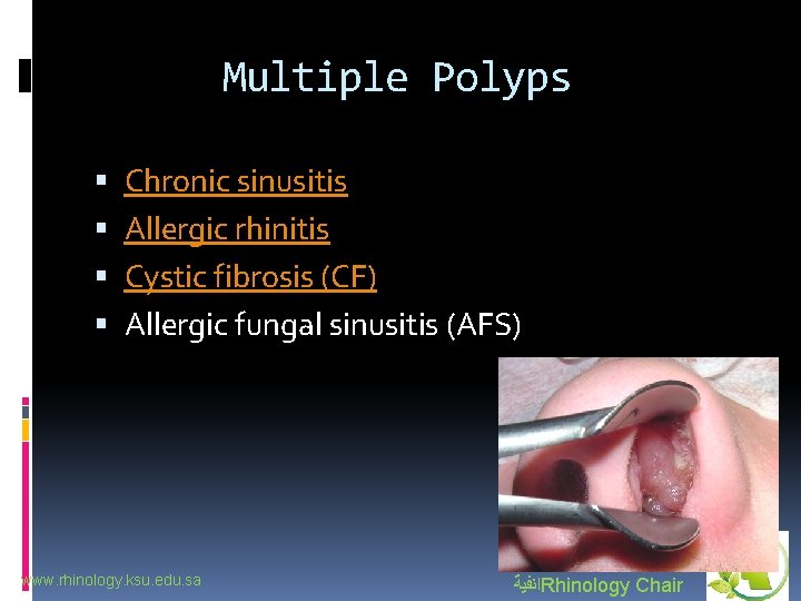 Multiple Polyps Chronic sinusitis Allergic rhinitis Cystic fibrosis (CF) Allergic fungal sinusitis (AFS) www.