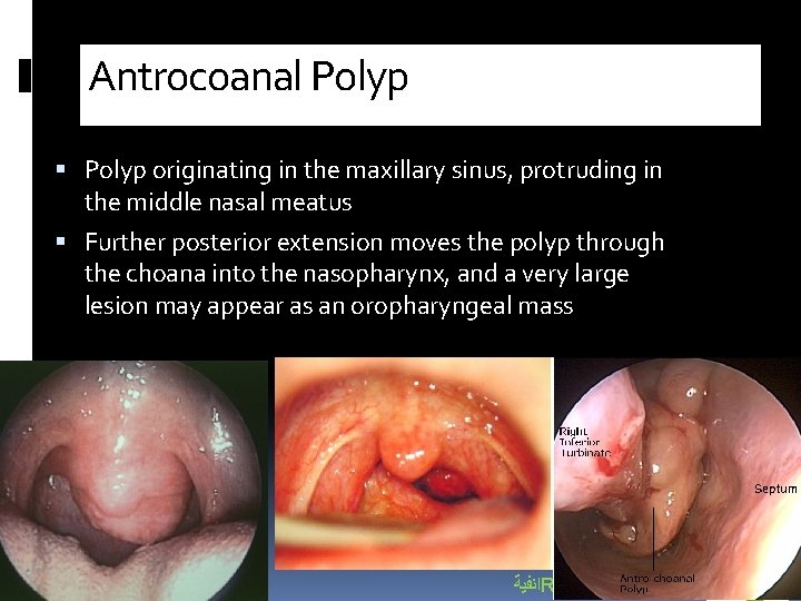 Antrocoanal Polyp originating in the maxillary sinus, protruding in the middle nasal meatus Further
