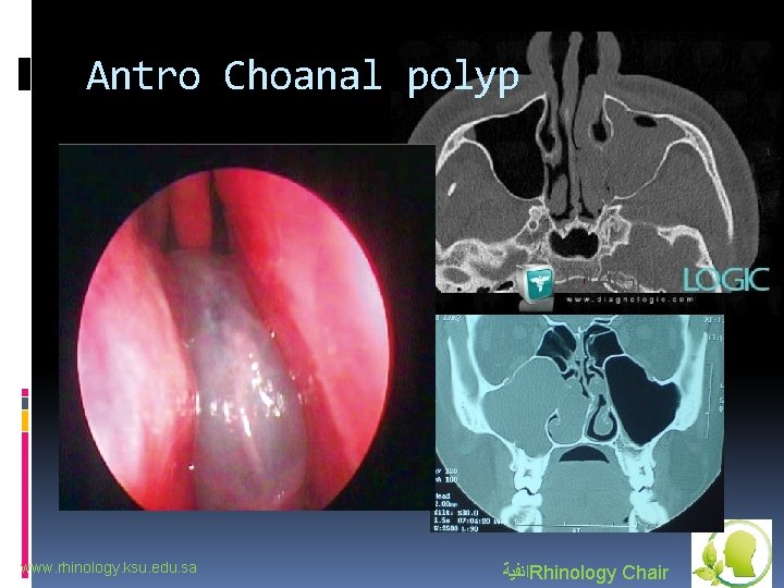 Antro Choanal polyp www. rhinology. ksu. edu. sa ﺍﻧﻔﻴﺔ Rhinology Chair 