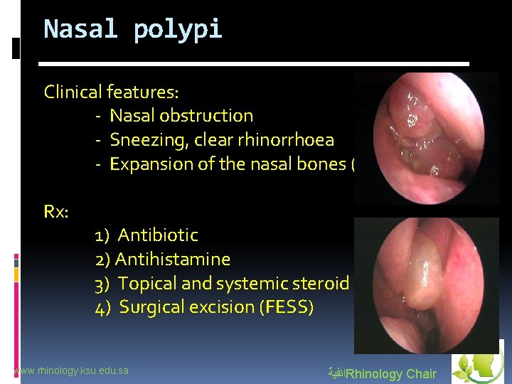 Nasal polypi Clinical features: - Nasal obstruction - Sneezing, clear rhinorrhoea - Expansion of