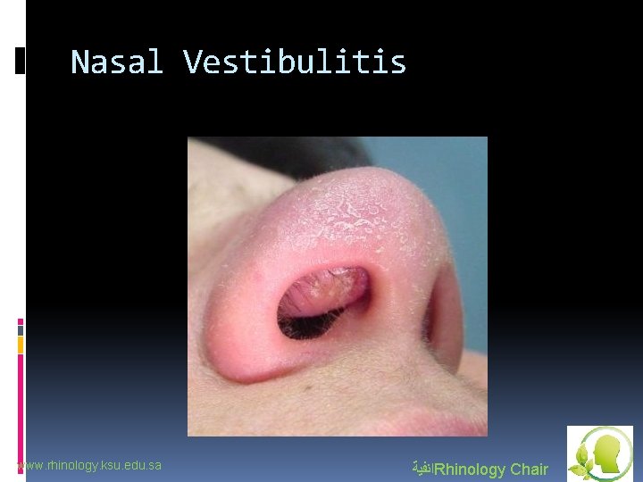 Nasal Vestibulitis www. rhinology. ksu. edu. sa ﺍﻧﻔﻴﺔ Rhinology Chair 