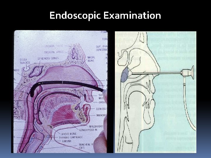 Endoscopic Examinationand Rigid Endoscopy. EX 