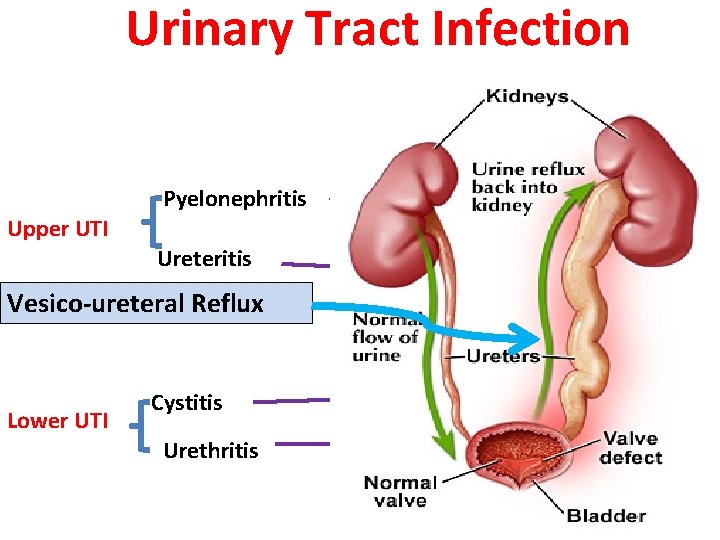 Urinary Tract Infection Pyelonephritis Upper UTI Ureteritis Vesico-ureteral Reflux Lower UTI Cystitis Urethritis 4