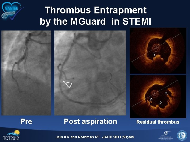 Thrombus Entrapment by the MGuard in STEMI Pre Post aspiration Jain AK and Rothman