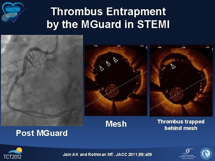 Thrombus Entrapment by the MGuard in STEMI Post MGuard Mesh Jain AK and Rothman