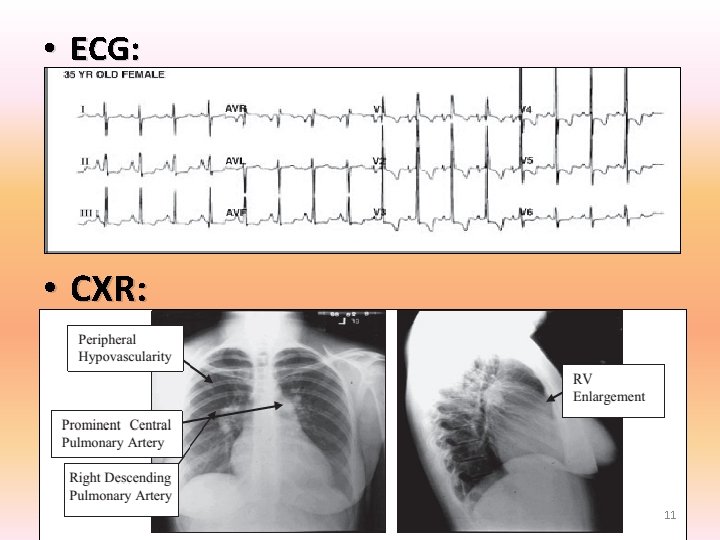 • ECG: • CXR: 11 • ECG: • CXR: 11