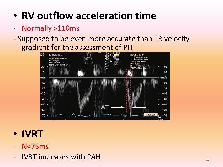 • RV outflow acceleration time - Normally >110 ms - Supposed to be • RV outflow acceleration time - Normally >110 ms - Supposed to be