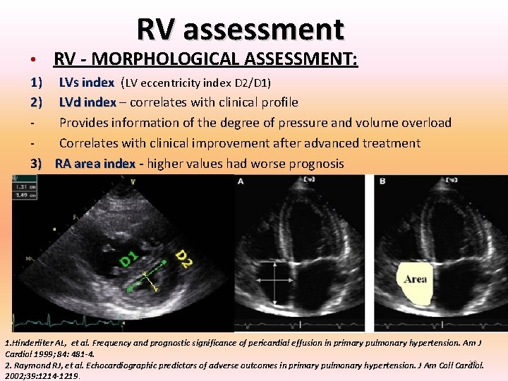 RV assessment • RV - MORPHOLOGICAL ASSESSMENT: 1) LVs index (LV eccentricity index D RV assessment • RV - MORPHOLOGICAL ASSESSMENT: 1) LVs index (LV eccentricity index D