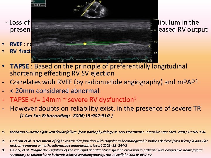 RV – FUNCTIONAL ASSESSMENT - Loss of peristaltic movements from sinus to infundibulum in RV – FUNCTIONAL ASSESSMENT - Loss of peristaltic movements from sinus to infundibulum in