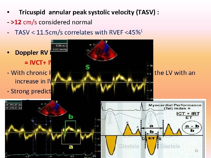 • Tricuspid annular peak systolic velocity (TASV) : - >12 cm/s considered normal • Tricuspid annular peak systolic velocity (TASV) : - >12 cm/s considered normal