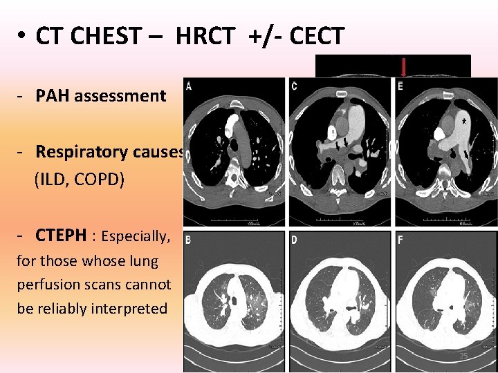 • CT CHEST – HRCT +/- CECT - PAH assessment - Respiratory causes • CT CHEST – HRCT +/- CECT - PAH assessment - Respiratory causes