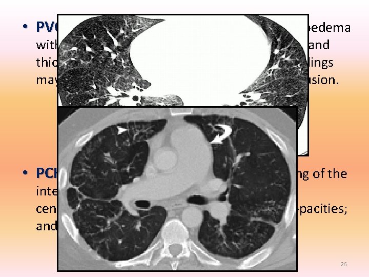• PVOD : Characteristic changes of interstitial oedema with diffuse central ground-glass opacification • PVOD : Characteristic changes of interstitial oedema with diffuse central ground-glass opacification