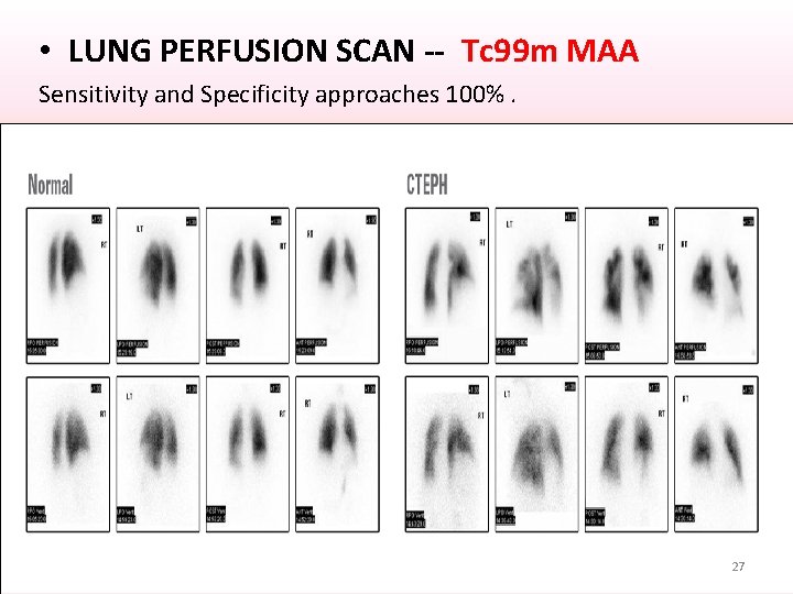 • LUNG PERFUSION SCAN -- Tc 99 m MAA Sensitivity and Specificity approaches • LUNG PERFUSION SCAN -- Tc 99 m MAA Sensitivity and Specificity approaches