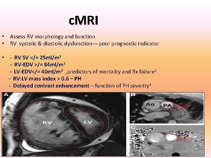 c. MRI • Assess RV morphology and function • RV systolic & diastolic dysfunction--- c. MRI • Assess RV morphology and function • RV systolic & diastolic dysfunction---